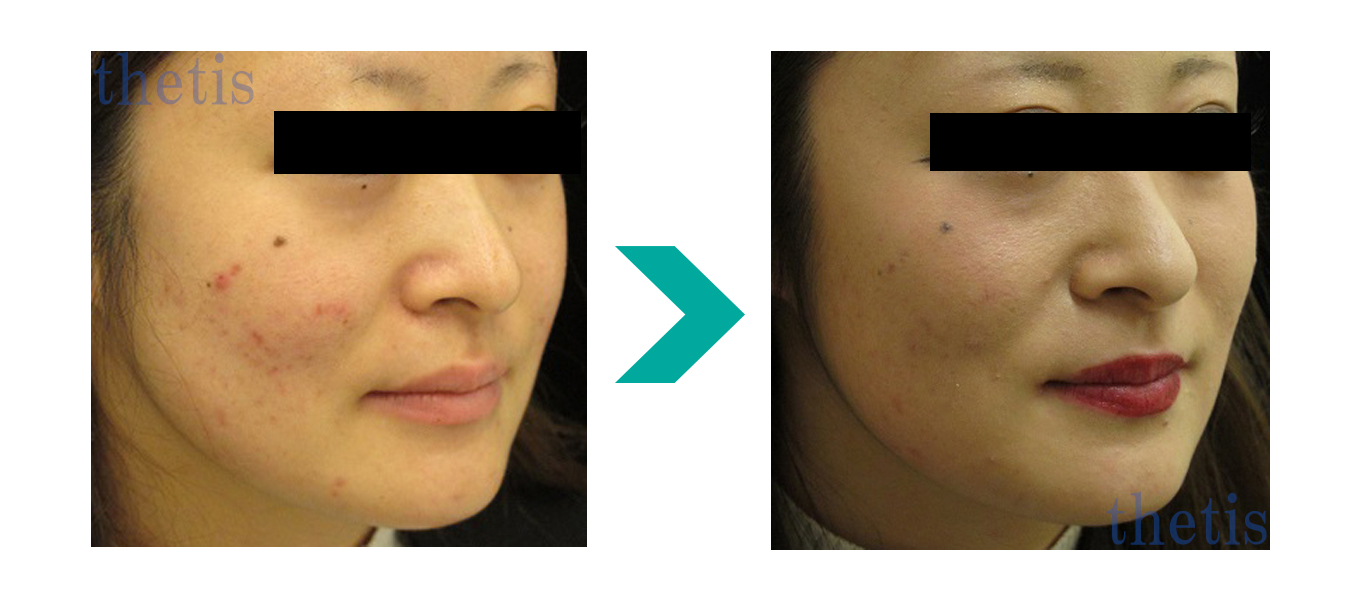 エラボトックス注射前後、テティス横濱美容皮膚科症例写真