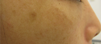 肝斑、炎症後色素沈着の症例写真